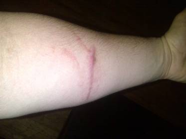 forearm scar from a motorcycle accident