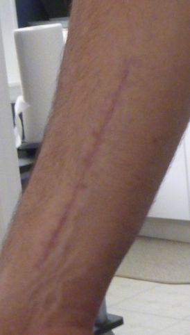 Photo showing scar from surgery on forearm