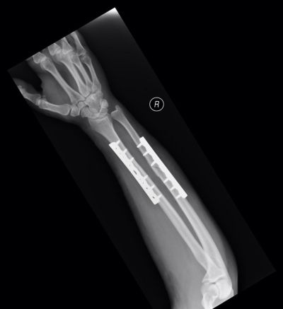 xray showing internal fixation on a broken wrist