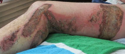 Burns from motorcycle accident