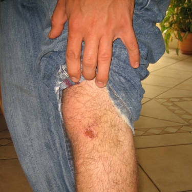 Knee Injury