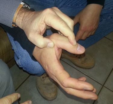 thumb-ligament-tear-optimized